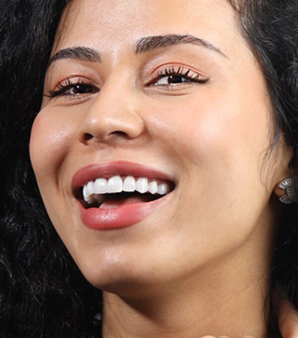Gummy Smile